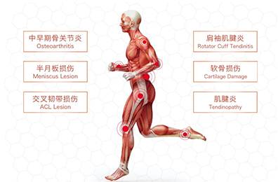 富血小板血浆PRP在运动医学运用及注意事项